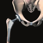 Accolade Stem with Trident Acetabular System