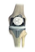 Scorpio NRG Total Knee System
