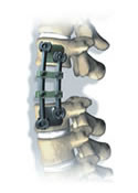 XIA Anterior System