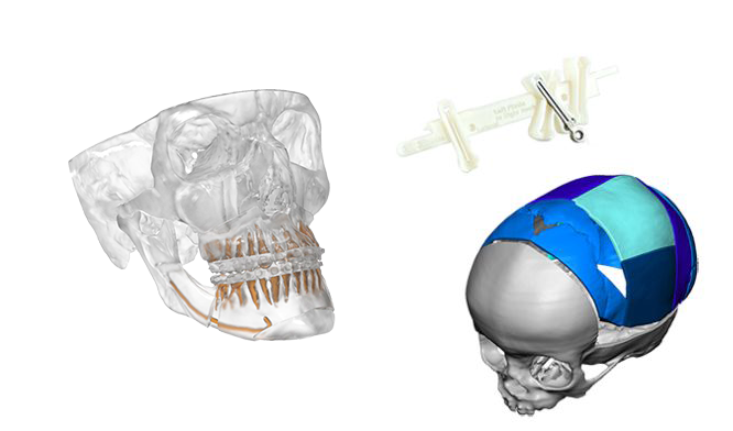 コンパス顔面骨骨折の治療 : Clinical Operation Manua… コンパス顔面