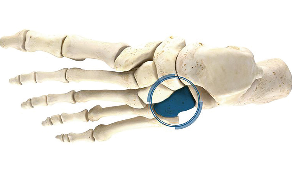 Cuboid Fracture Stryker