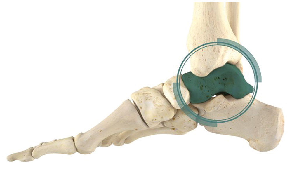Фото стопы кости суставы. Таранная кость стопы анатомия. Таранная кость голеностопного сустава. Таранная кость перелом. Таранчатая кость стопы.