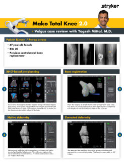 Mako Total Knee 2.0 - Valgus case review with Yogesh Mittal, M.D.