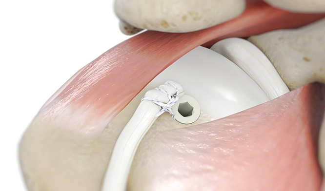 Arthroscopic Rotator Cuff Repair and Bicep Tenodesis: Right