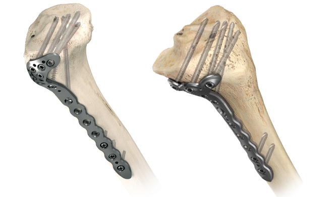 AxSOS 3 Ti do proksymalnej części kości piszczelowej | Stryker