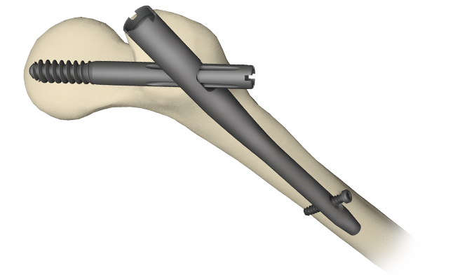 Retrospective Study Of Proximal Femoral Nail In Management Of Unstable  Trochanteric Fractures Of Femur | Kandel | International Journal of  Orthopaedics