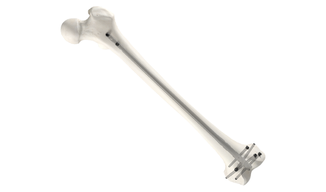 Blocking screws: an adjunct to retrograde nailing for distal femoral shaft  fractures