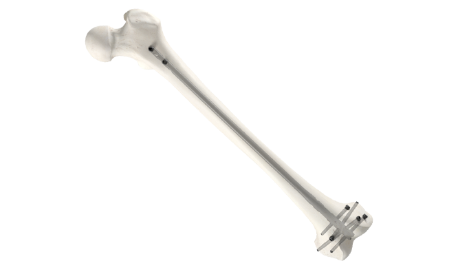 Proximal femoral nail | Radiology Reference Article | Radiopaedia.org