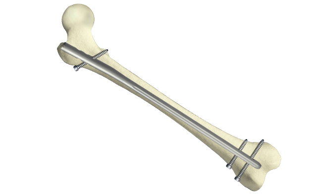Retrograde Left Femoral Nailing Surgery (Intramedullary rodding) -  Medivisuals Inc.