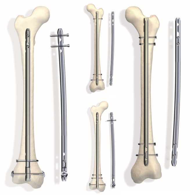 Blocking screws: an adjunct to retrograde nailing for distal femoral shaft  fractures