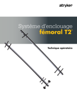 Système d'enclouage fémoral T2® Technique opératoire