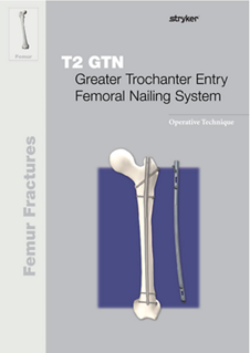 T2 GTN Greater Trochanter Entry Femoral Nailing System