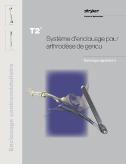 Technique opératoire T2 Arthrodèse de genoux