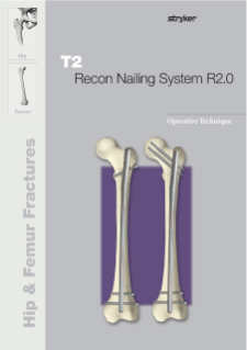 T2 Recon Nail R2.0 operative technique