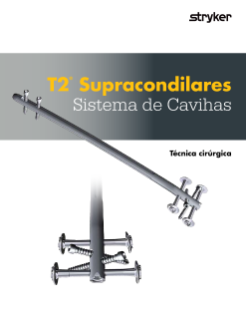 T2® Supracondilares Sistema de Cavihas Técnica cirúrgica