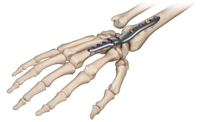 VariAx 2 Wrist Fusion Locking Plate System | Stryker